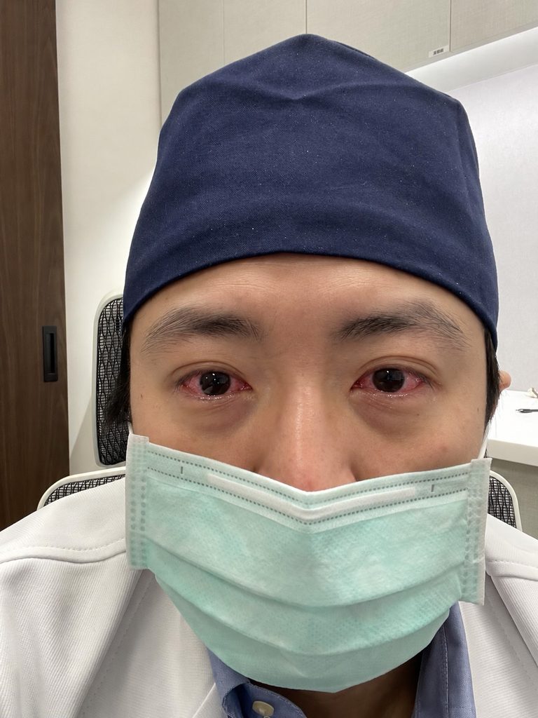 眼科醫師自己也中招！病毒性結膜炎到底有多會傳？