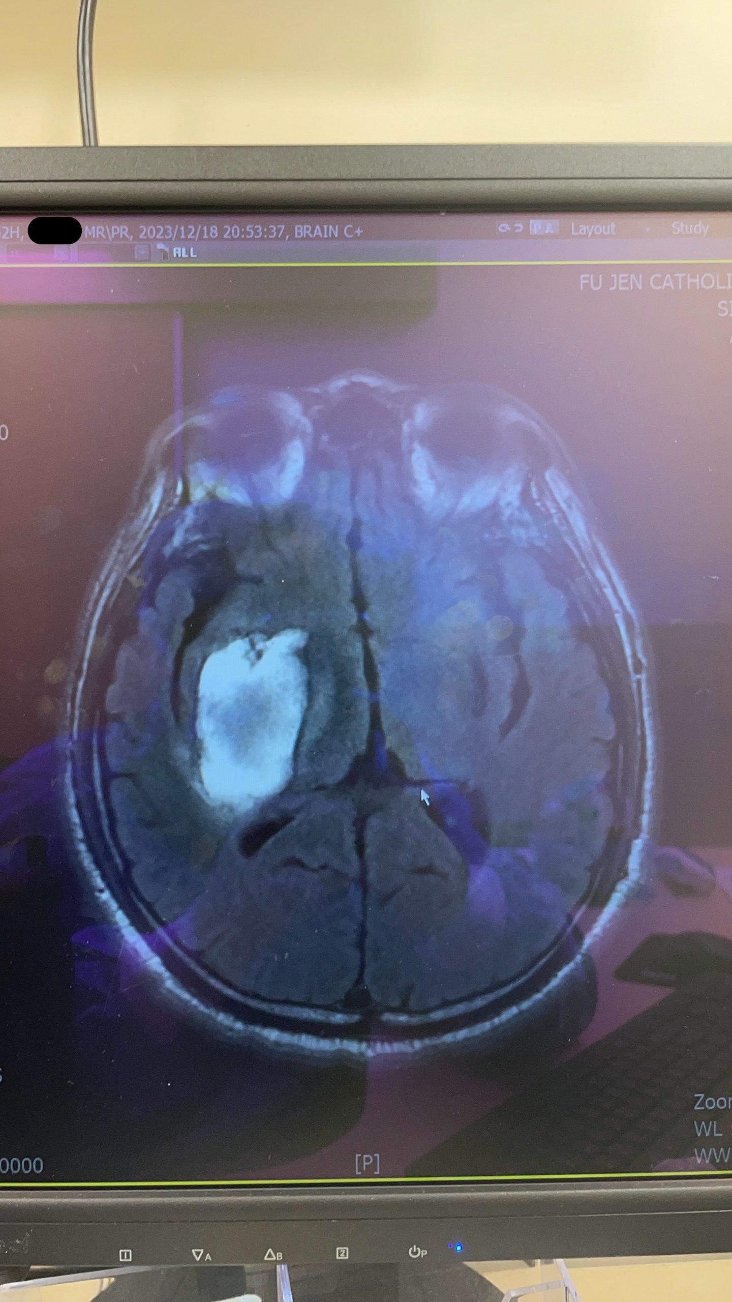 腦腫瘤mri