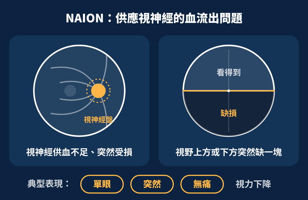 打瘦瘦針會影響視力嗎?眼科醫師提醒:有兩件事值得注意 naion
