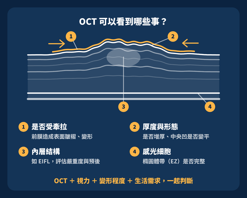黃斑前膜視力還不錯,為什麼看東西變形也值得評估? oct可以看到什麼