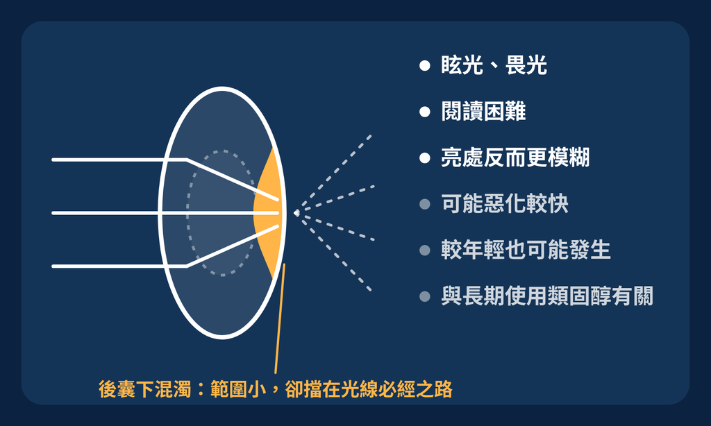 白內障不只一種!認識白內障的三大分類 後囊下白內障