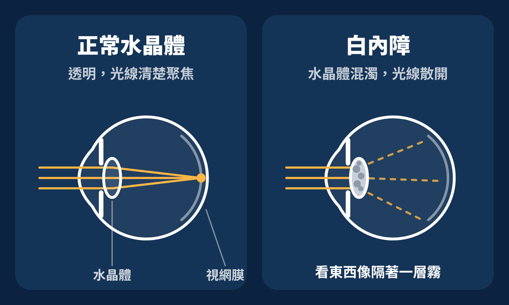 正常vs白內障