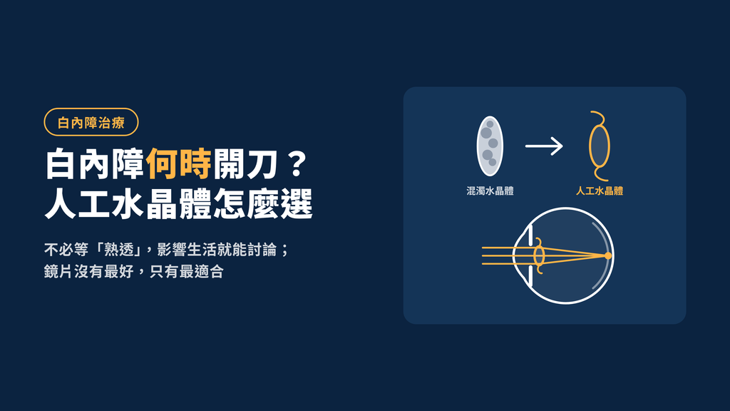 白內障何時開刀 文章頂圖
