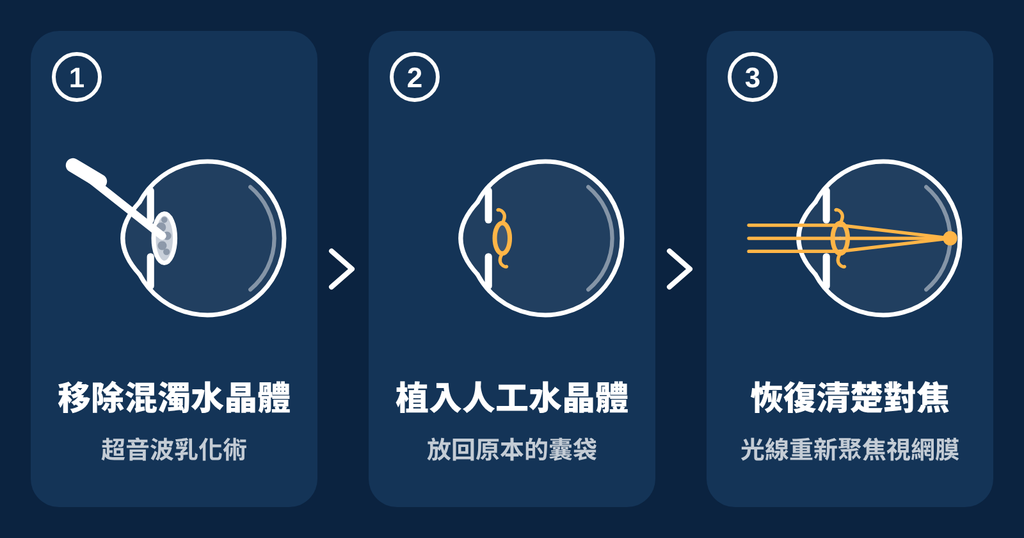 白內障手術