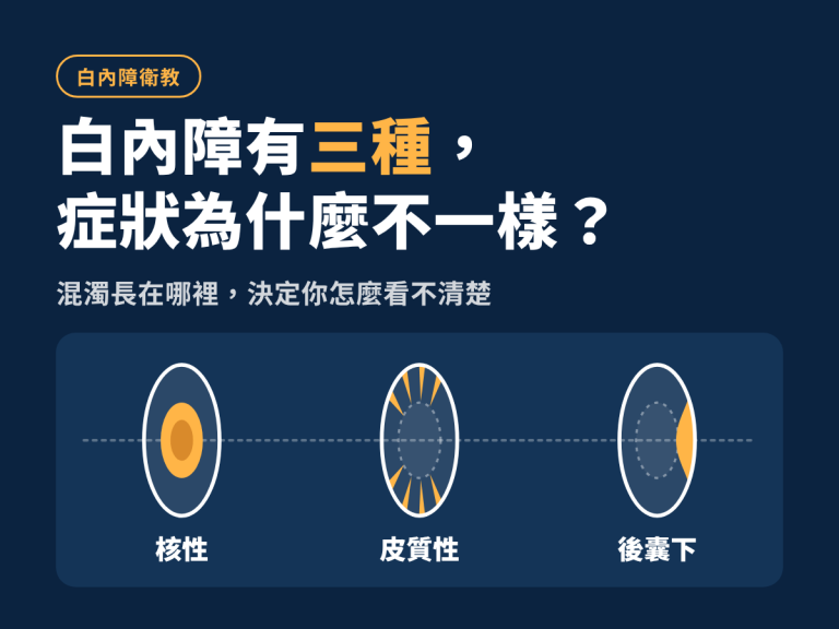 白內障不只一種！認識白內障的三大分類