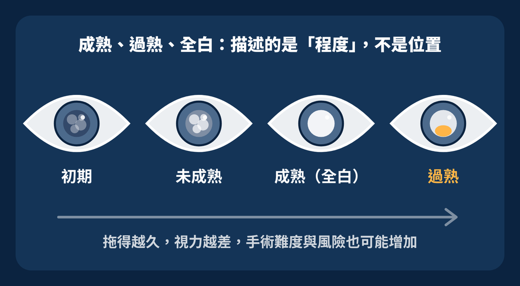 白內障不只一種!認識白內障的三大分類 白內障過熟