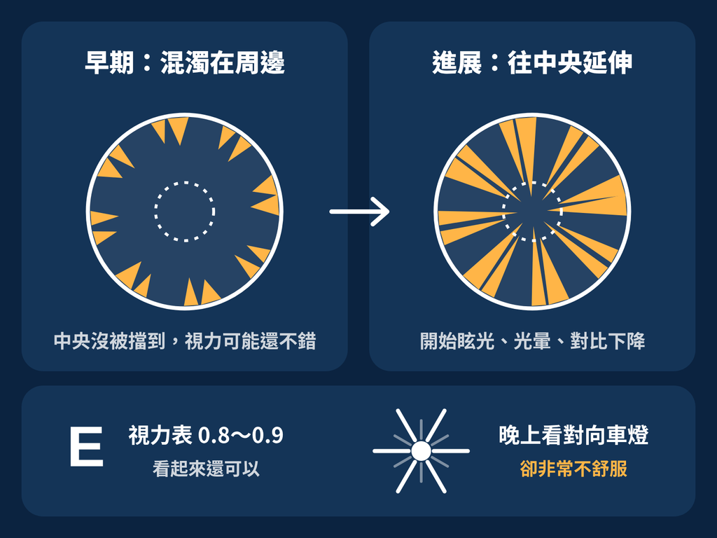 白內障不只一種!認識白內障的三大分類 皮質性白內障