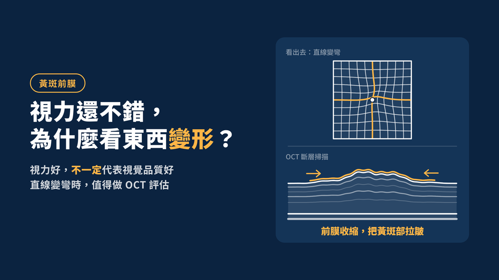 黃斑前膜視力還不錯,為什麼看東西變形也值得評估? 看東西為何變贏 首圖