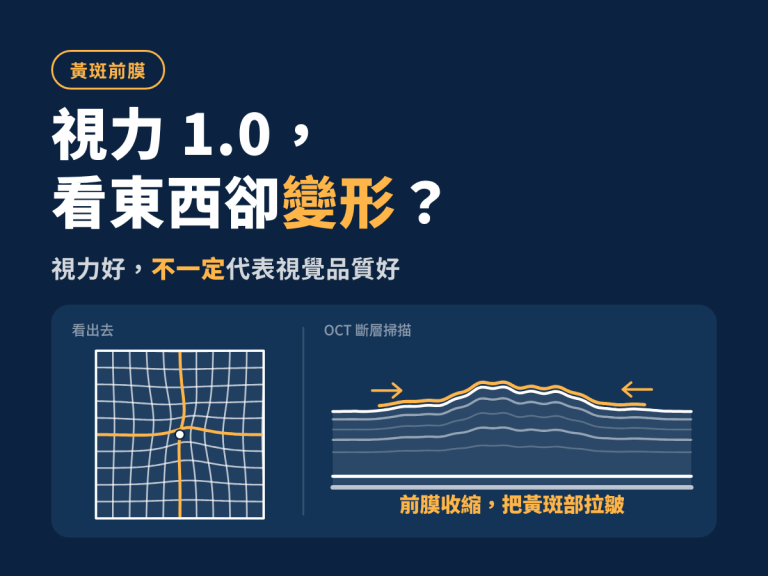 黃斑前膜視力還不錯，為什麼看東西變形也值得評估？
