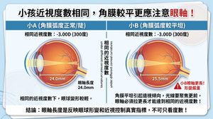 角膜平，多注意眼軸