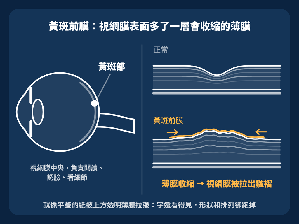 黃斑前膜視力還不錯,為什麼看東西變形也值得評估? 黃斑前膜