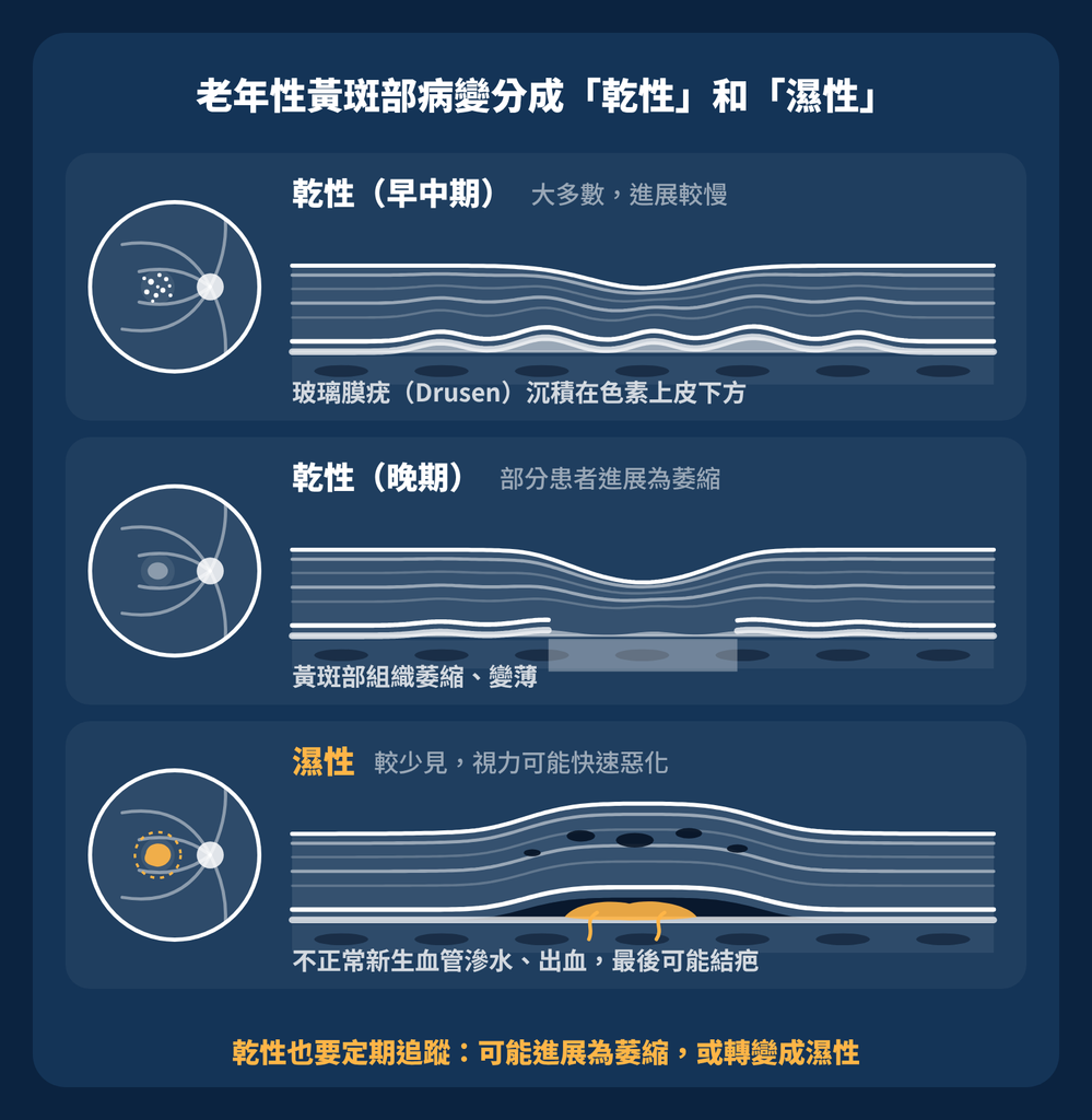 老年性黃斑部病變:看東西變形,千萬不要只以為是老花 黃斑部病變乾性濕性